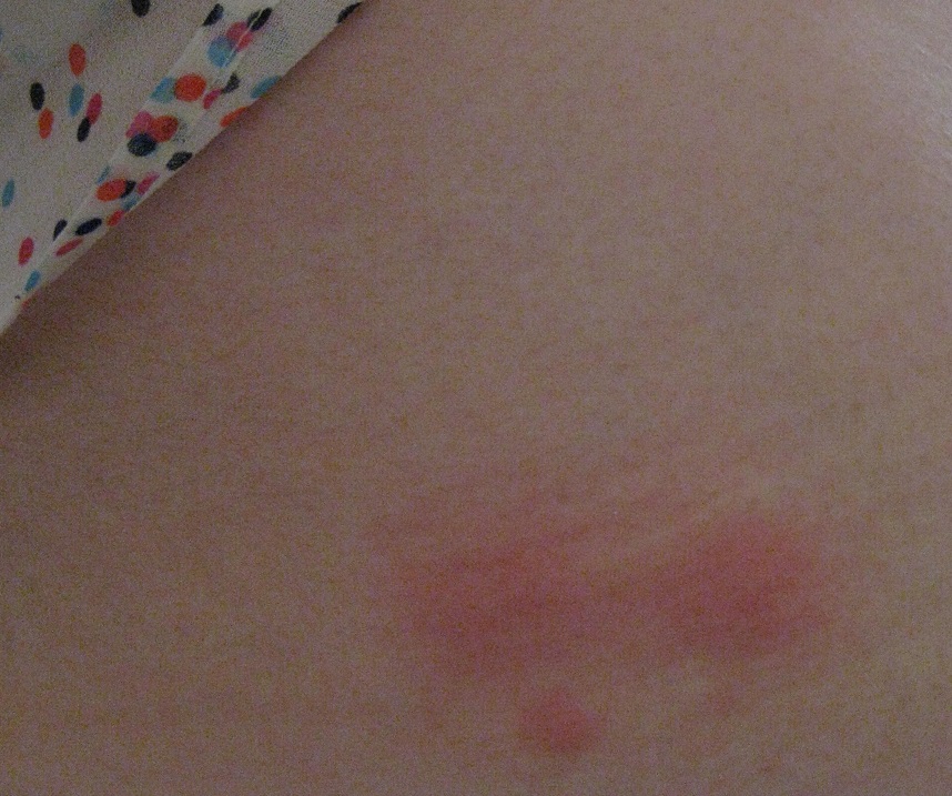 Mosquito Bites